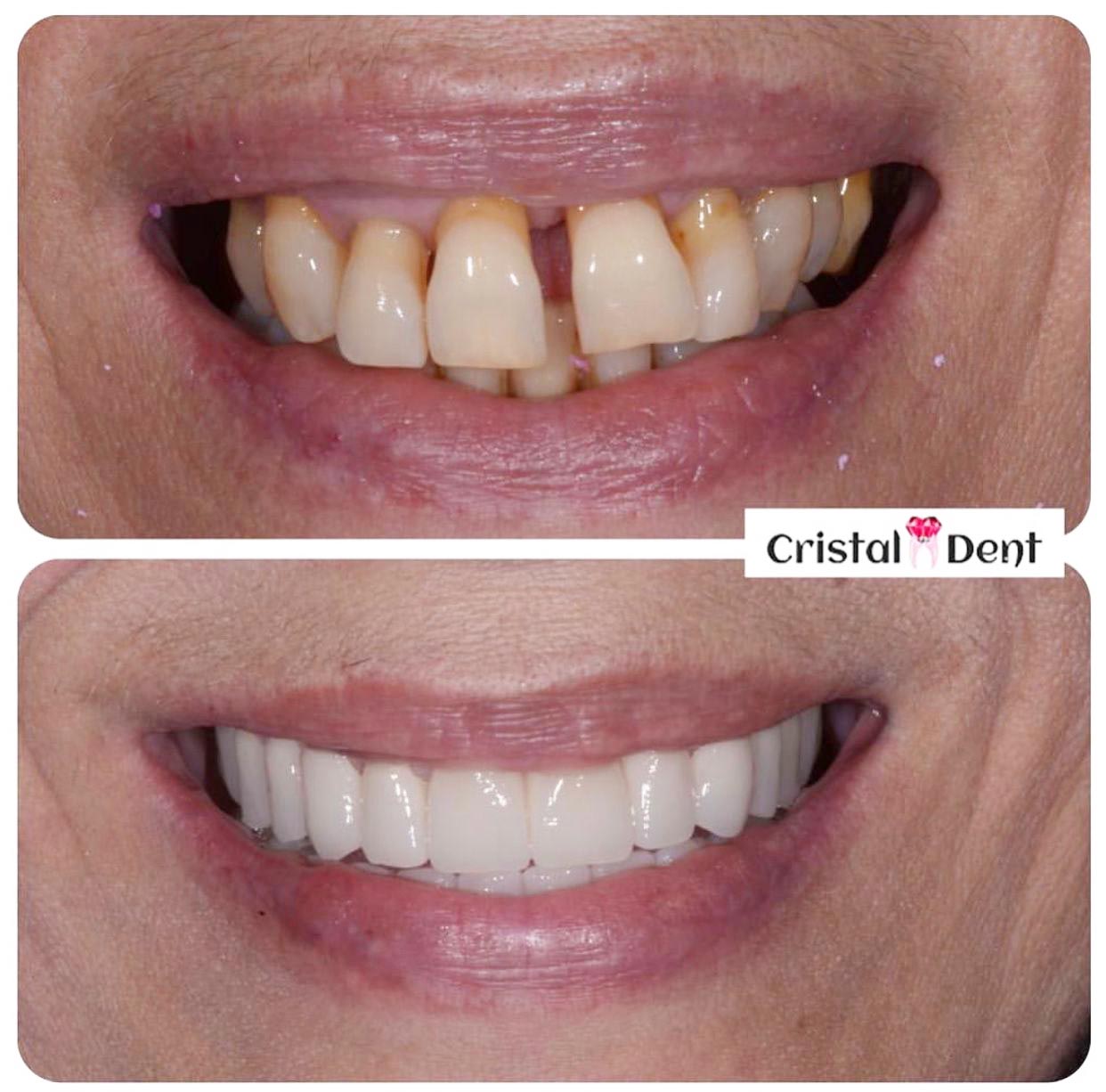 casi clinici implantologia dentale studio cristaldent torino