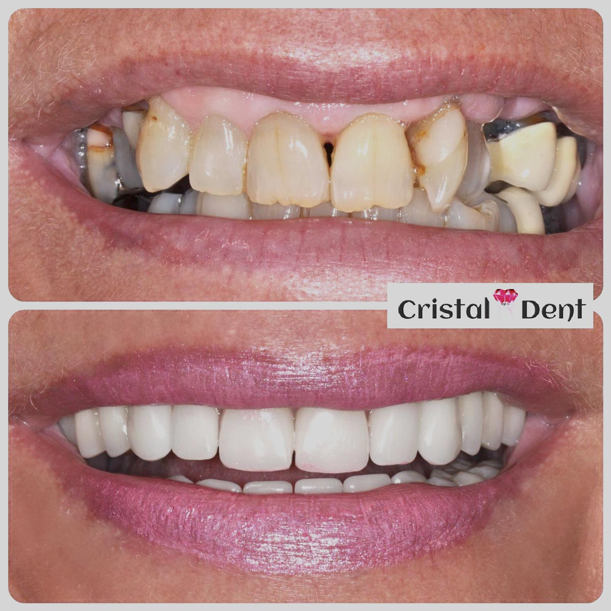 casi clinici implantologia dentale studio cristaldent torino