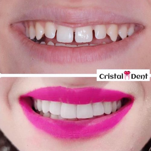 casi clinici estetica dentale studio cristaldent torino