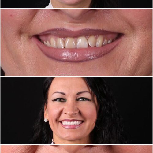 casi clinici estetica dentale studio cristaldent torino